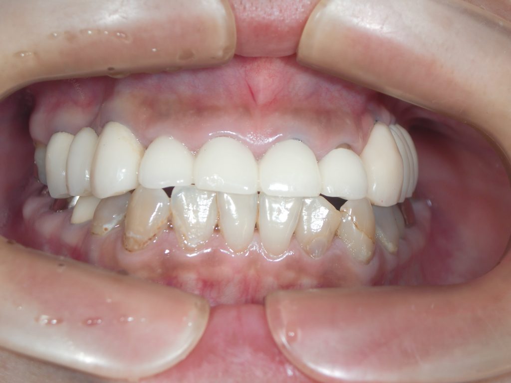 2018年 5月に完治の症例 （30歳代女性 上あご左臼歯部インプラント） 笹尾歯科医院