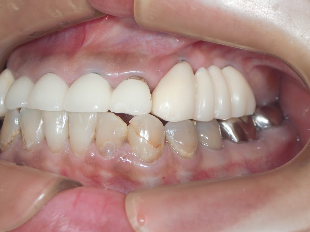 2018年 5月に完治の症例 （30歳代女性 上あご左臼歯部インプラント） 笹尾歯科医院